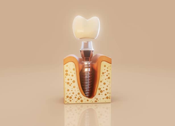 Conceptual 3D illustration of a dental implant inside the jawbone